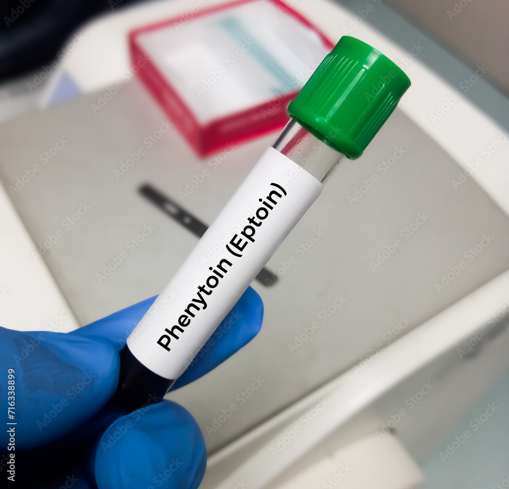Blood sample for Phenytoin test, therapeutic drug, to maintain a therapeutic level and diagnose potential for toxicity. Blood sample for Phenytoin test, therapeutic drug, to maintain a therapeutic level and diagnose potential for toxicity.