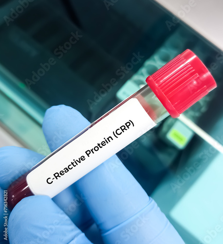 Blood sample for CRP(C-reactive protein) test used to identify inflammation or infection in the body. photo