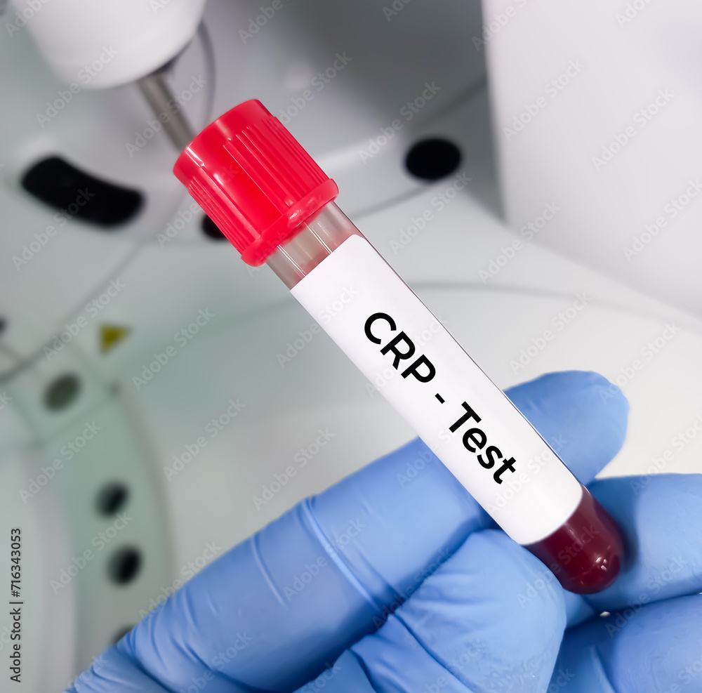 Blood sample for CRP(C-reactive protein) test used to identify inflammation or infection in the body.