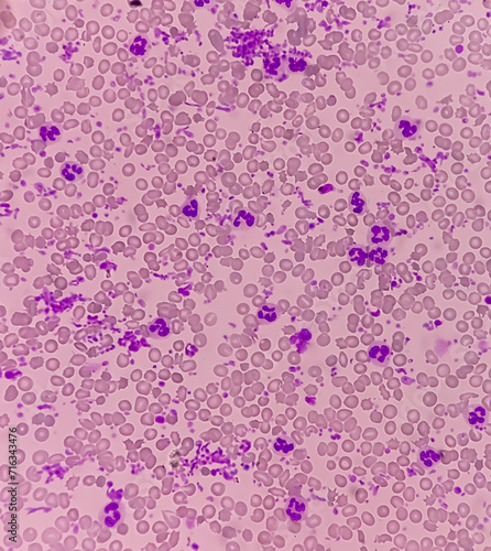 Essential thrombocytosis blood smear showing abnormal high volume of platelet and White Blood Cells. Panmyelosis. Myeloprokiferative disorder. photo