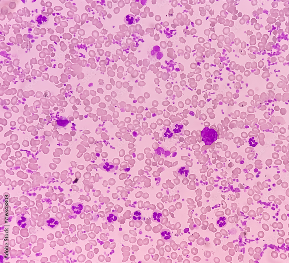 Essential thrombocytosis blood smear showing abnormal high volume of platelet and White Blood Cells. Panmyelosis. Myeloprokiferative disorder.