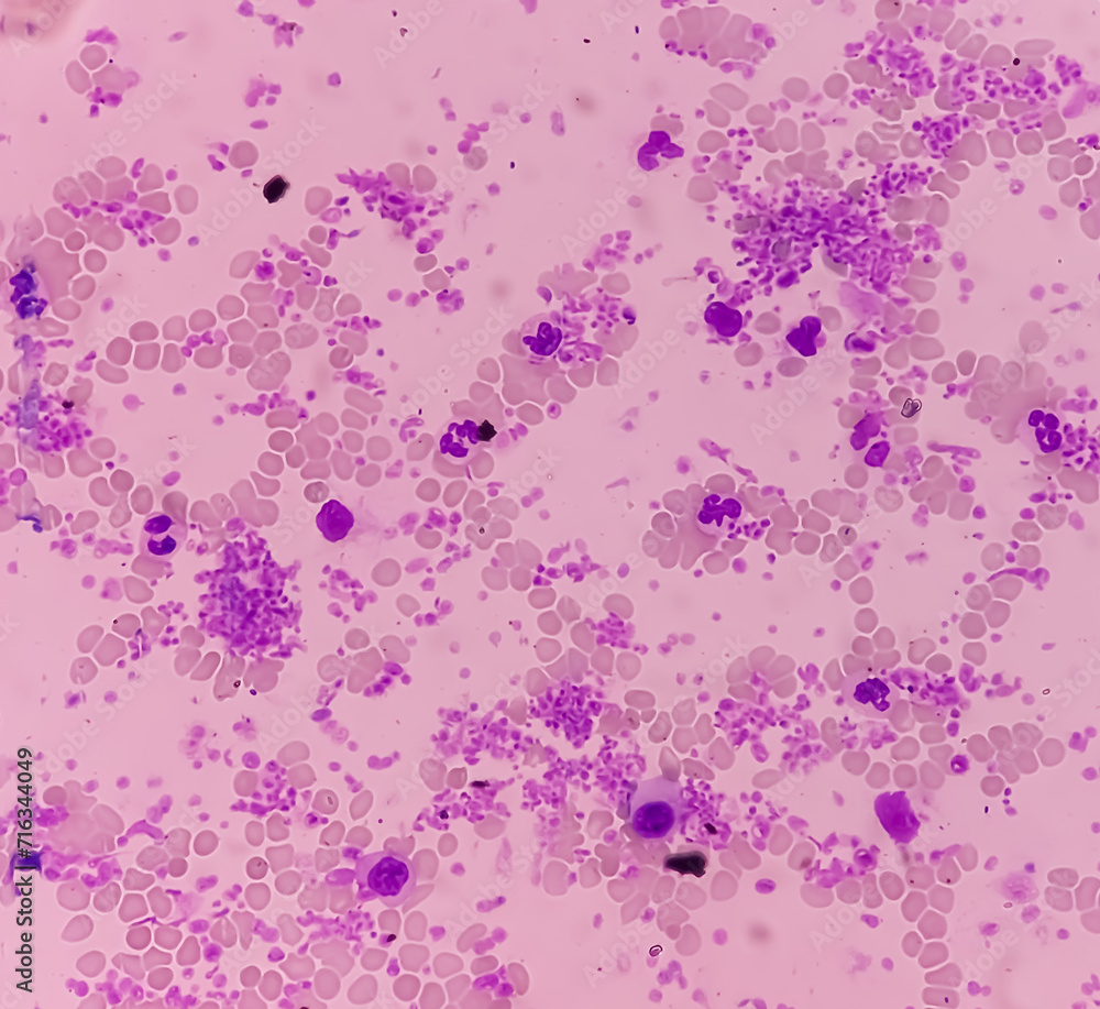 Essential thrombocytosis blood smear showing abnormal high volume of platelet and White Blood Cells. Panmyelosis. Myeloprokiferative disorder. Essential thrombocytosis blood smear showing abnormal high volume of platelet and White Blood Cells. Panmyelosis. Myeloprokiferative disorder.