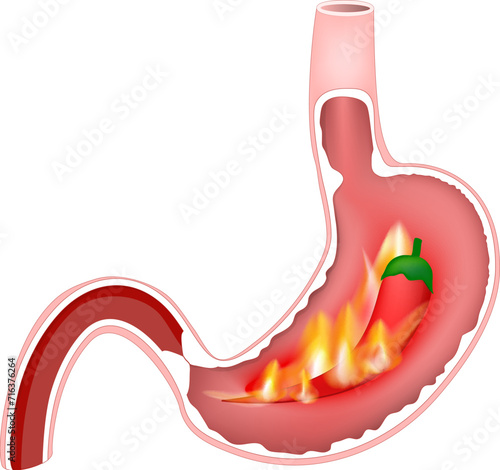 Cross section of stomach with hot flames and red chili pepper.