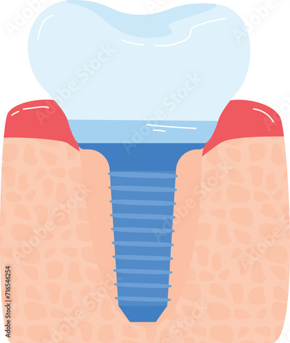 Close-up of a dental implant in the jawbone showing structure and gums. Detailed anatomy of tooth replacement. Medical diagram of dental prosthetics vector illustration.