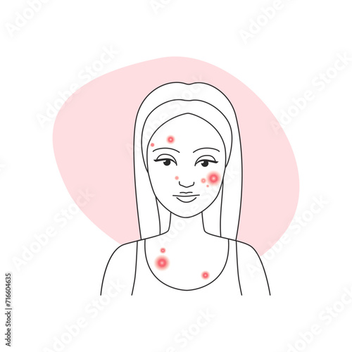 Sad young woman with pimply skin on face before acne treatment vector illustration