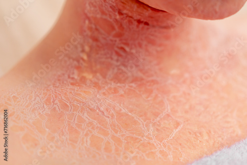 close-up of inflamed red crusted skin dermatology desquamation disease