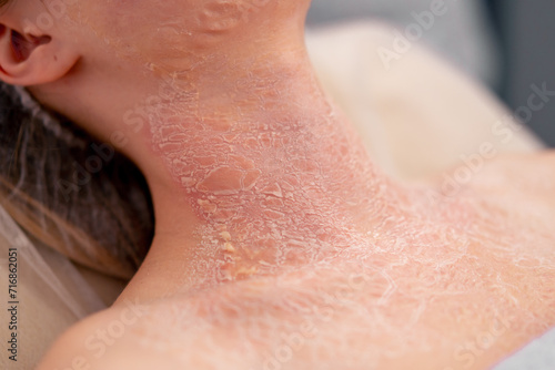 close-up of inflamed red crusted skin dermatology desquamation disease
