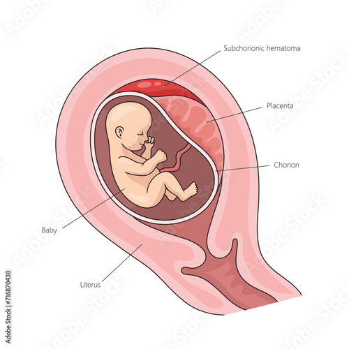 Placental abruption structure diagram hand drawn schematic vector illustration. Medical science educational illustration