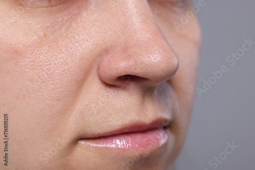 Closeup view of woman with comedones on her nose against grey background