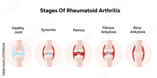 Medical infographic stage of rheumatoid arthritis joints 