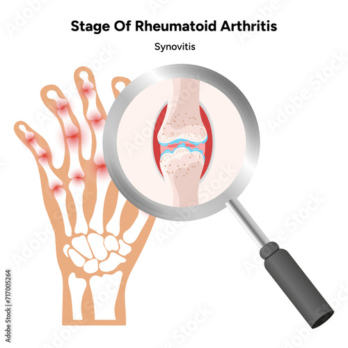 Medical infographic stage of rheumatoid arthritis joints synovitis