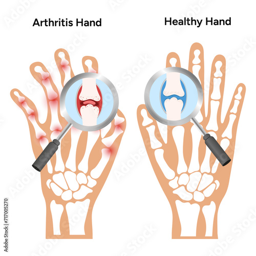 Medical illustration arthritis and healthy nahds