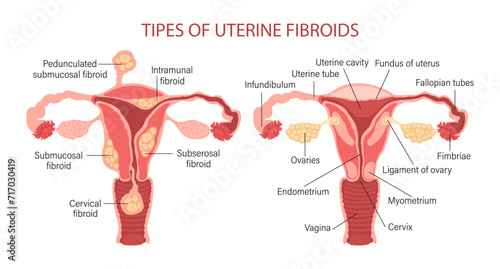 Types of uterine fibroids in women. Fibroids. Diseases of the female reproductive system. Gynecology. Medical concept. Infographic banner. Vector photo