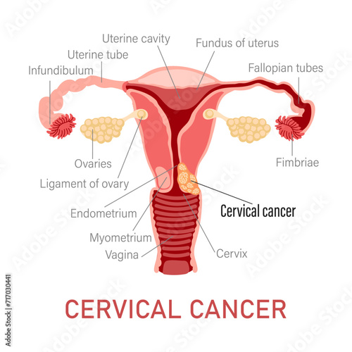 Cervical cancer. Diseases of the female reproductive system. Gynecology. Medical concept. Infographic banner. Vector