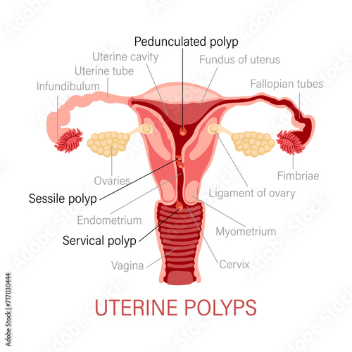 Types of uterine polyps. Diseases of the female reproductive system. Gynecology. Medical concept. Infographic banner. Vector photo