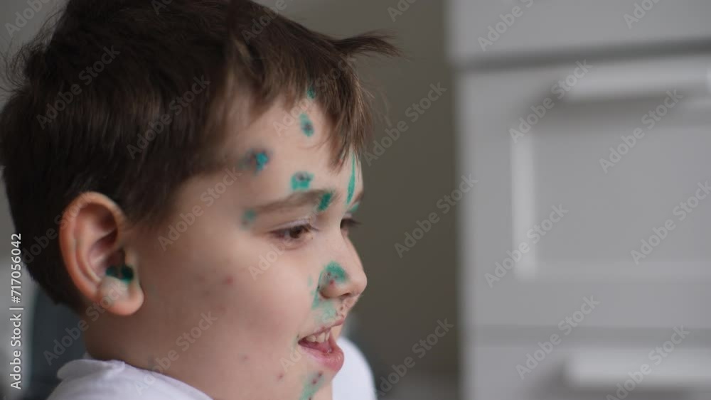 Closeup face of cheerful sick child boy whose face covered with pimples