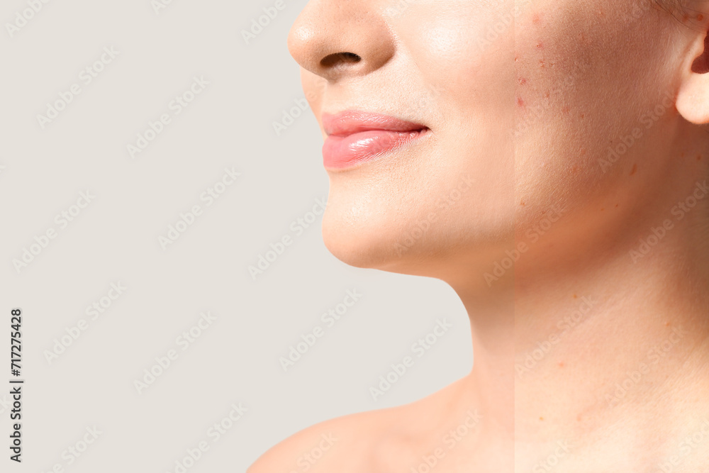 Young woman before and after acne treatment on light background with space for text, closeup Young woman before and after acne treatment on light background with space for text, closeup