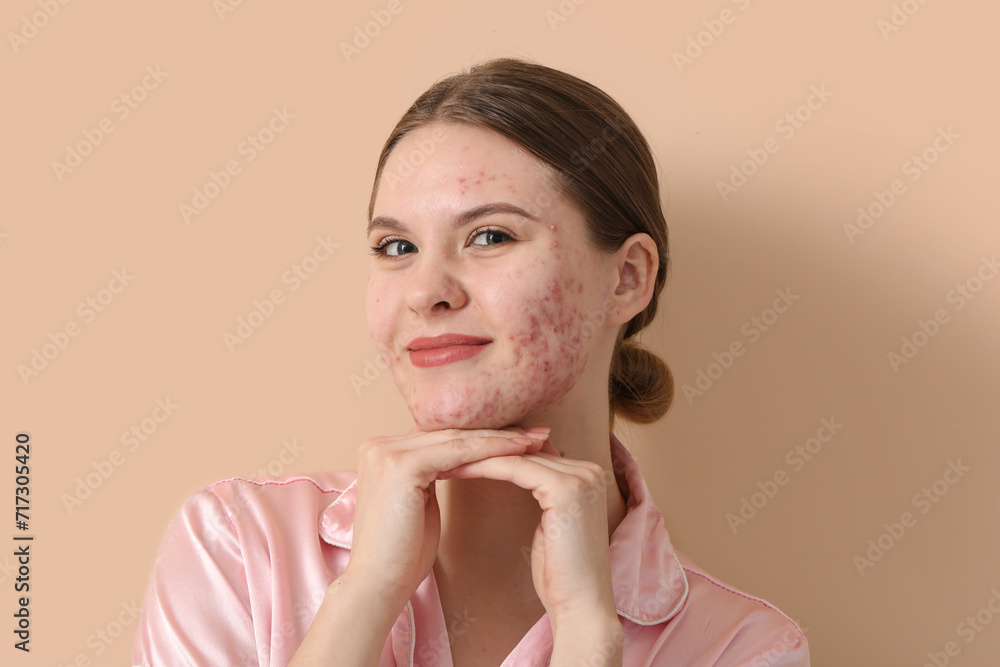 Young woman with acne problem on beige background, closeup Young woman with acne problem on beige background, closeup