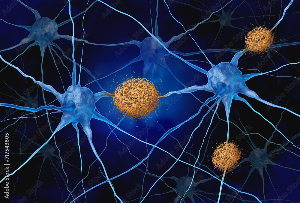 Amyloid Plaques concept as abnormal clusters of protein fragments that