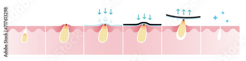 Cross section of blackhead acne and how to remove pimple vector isolated on white background. Wet the skin, apply, peel off, unclogging and tighten pore. Skin care and beauty concept illustration.