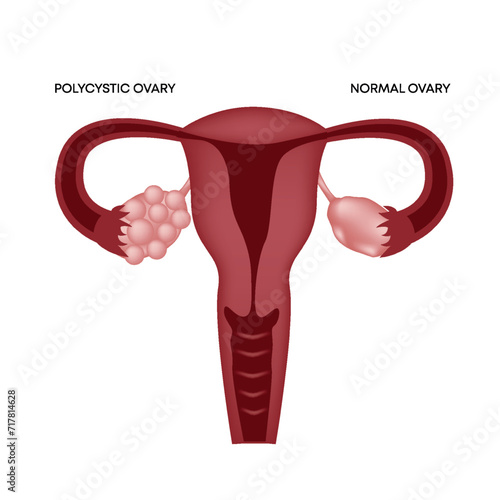 The uterus and the polycystic ovary. Female reproductive system. Vector illustration