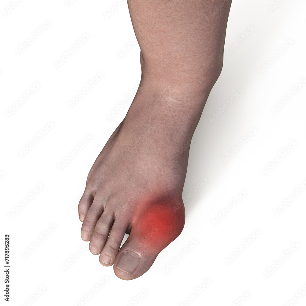 Gout-afflicted foot, 3D illustration Gout-afflicted foot, 3D illustration