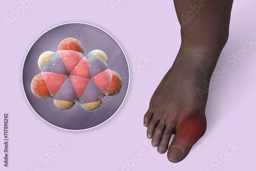 Gout-afflicted foot, 3D illustration photo