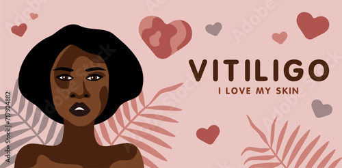 Banner about vitilingo skin disease with young beautiful African American woman minimalistic vector