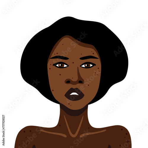 Young African American woman with acne on her body on white background vector illustration in minimalistic style