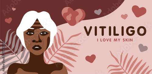 Banner about vitilingo skin disease with elderly African American woman minimalistic vector