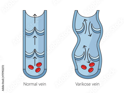 healthy and varicose veins structure diagram hand drawn schematic vector illustration. Medical science educational illustration