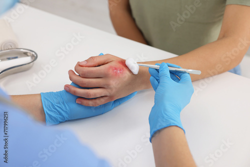 Doctor treating patient's burned hand at table, closeup