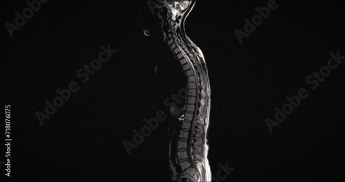 Grungy and highly textured vintage MRI scan of multiple smaller scans stitched together to form a full back MRI scan of a middle aged woman photo