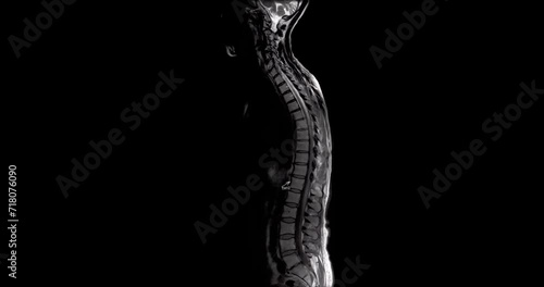 MRI scan of the full spine of a woman going side to side photo