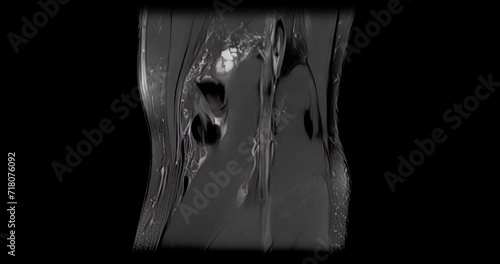 MRI scan of an injured male knee, scanning from side to side photo