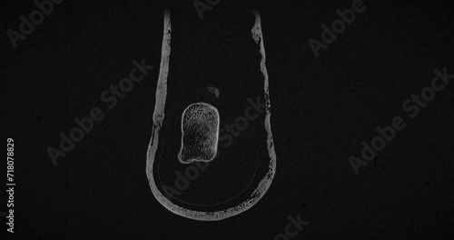 MRI scan of a male foot scanning from front to back slowly, showing multiple small fractures spread throughout the entire foot after bike accident photo