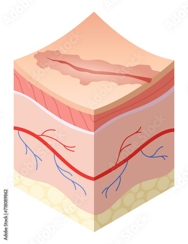 Skincare medical concept. Problems in cross-section of human skin horizontal layers structure. Anatomy illustrative model unhealthy layer of skin