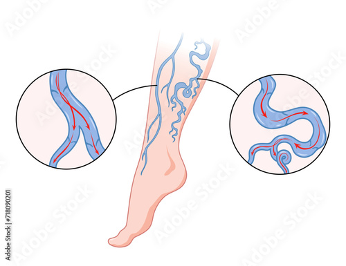 Varicose veins. Blue blood vessel visible through the skin, abnormally swollen leg. Vascular disease diagnostic and treatment. Venous insufficiency medical disease