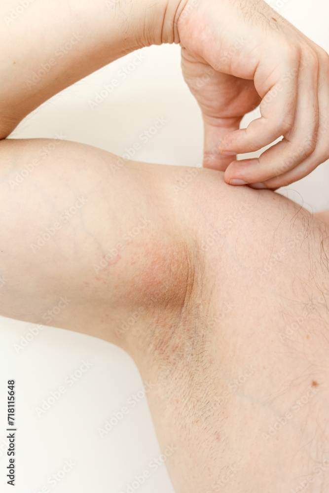 Armpit rash. Unrecognisable man shows irritation on the sensitive skin after using a razor, trimmer, deodorant or antiperspirant. Allergy, irritation or atopic dermatitis. Acne or red spots underarm. Armpit rash. Unrecognisable man shows irritation on the sensitive skin after using a razor, trimmer, deodorant or antiperspirant. Allergy, irritation or atopic dermatitis. Acne or red spots underarm.