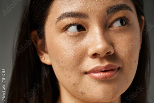 close up shot of young and brunette asian woman with acne prone skin looking away, skin issues photo
