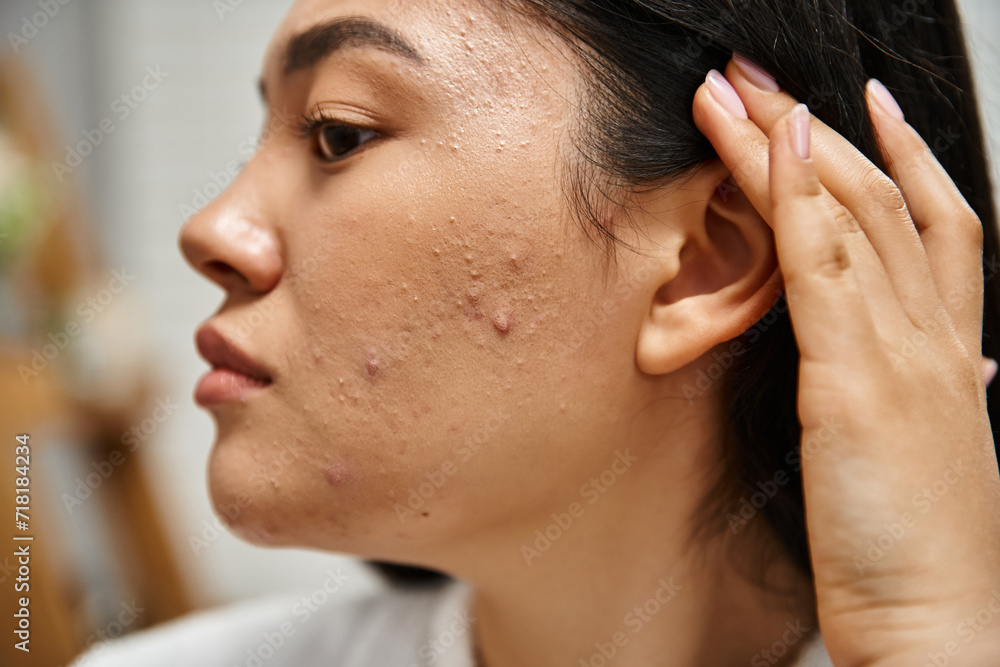 skin care issues concept, close up shot of young asian woman with brunette hair and acne on face