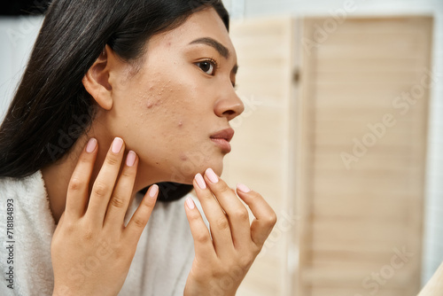 Quadro su tela young asian woman with brunette hair examining her skin with acne in the mirror,