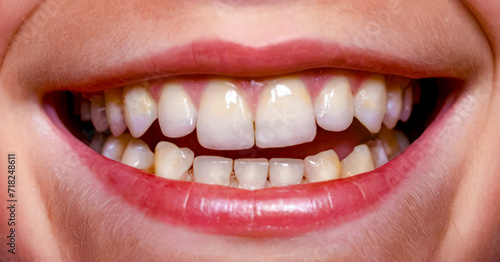 Close up of person's mouth with missing teeth and gums.