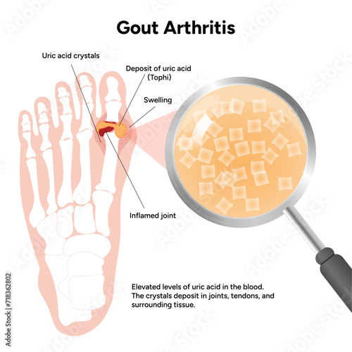 Medical infographic gout arthritis in the foot 