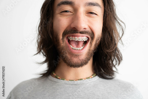 close up of a young adult Latin man's mouth with dental braces laughing and looking into the camera