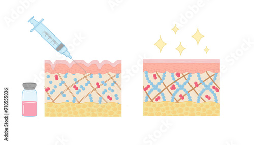 hyauronic acid injection, diagram. illustration in cartoon style.