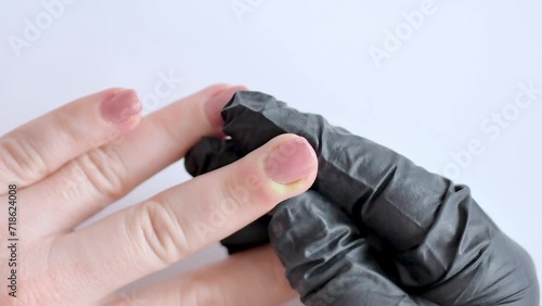 A doctor in a black rubber glove touches a patient's purulent abscess with his finger. Paronychia is an inflammation of the periarticular roller. Treatment of dermatological inflammations. photo