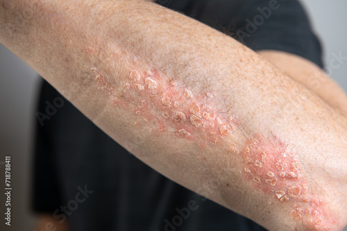 
Psoriasis, a skin disease