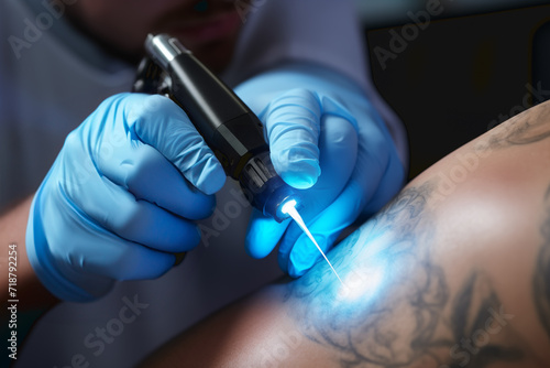 A boy removes a tattoo from his back with laser treatment