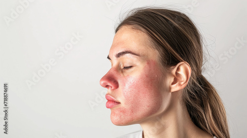 young woman with skin problem rosacea on the face. Medicine and cosmetology. rosacea skin condition.
 photo